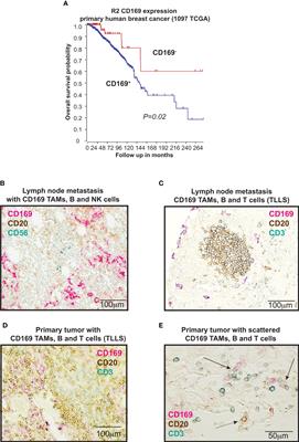 Breast cancer associated CD169+ macrophages possess broad immunosuppressive functions but enhance antibody secretion by activated B cells